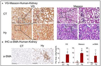 THBS1/CD47 Modulates the Interaction of γ-Catenin With E-Cadherin and Participates in Epithelial–Mesenchymal Transformation in Lipid Nephrotoxicity